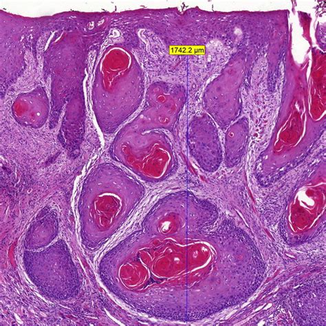 Histopathological Slide Of An Oral Squamous Cell Carcinoma Showing