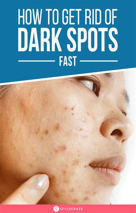 6 Home Remedies To Remove Dark Spots On Face Causes And Types Remove