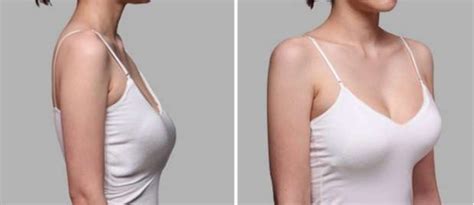 Форма груди анатомическая Фото до и после увеличения груди анатомическими имплантами