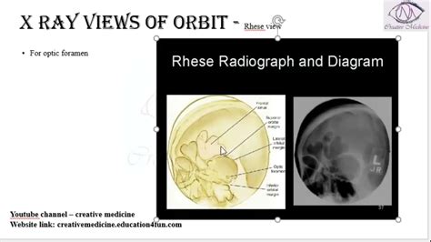 Lec 4 X Ray Views Of Orbit Rhese View Mp4 Youtube