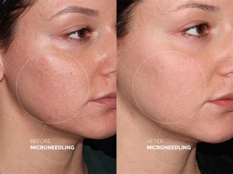 Microneedling Before After Dr Erickson Dermatology My Xxx Hot Girl