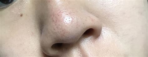 Check spelling or type a new query. skin concern Super clogged (and dark) pores on my nose ...