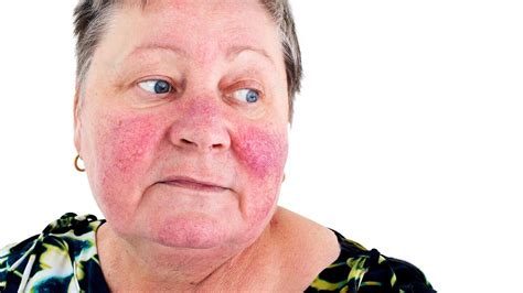 Common Skin Rashes Everyday Health