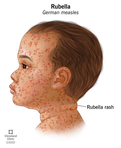 Rubella German Measles Symptoms Treatment Prevention