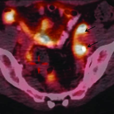 A Positron Emission Tomography Computed Tomography Pet Ct Scan Shows