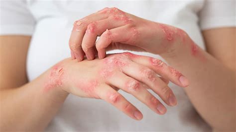 Psoriasis Expert Explains Symptoms Complications And Treatment