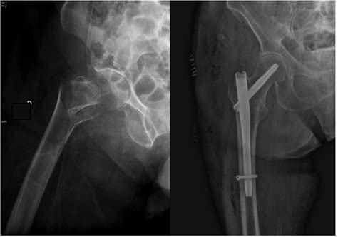 Jcm Free Full Text Treatment Of Trochanteric Hip Fractures With