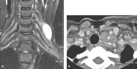 Cervicothoracic Junction Brachial Plexus Benign And Malignant Tumors