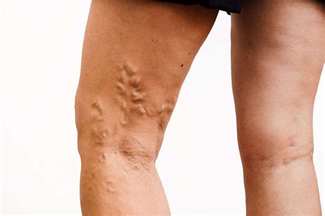 The Causes And Treatment Of Varicose Veins Novus Spine And Pain Center