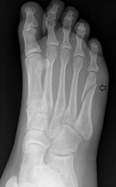 Oblique View Of A Foot Series Demonstrating A Minimally Displaced