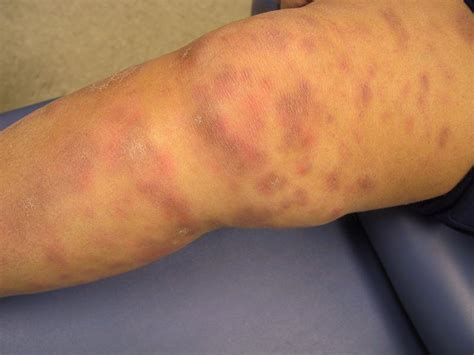 Erythema Nodosum Pictures Causes Symptoms Diagnoses Treatment