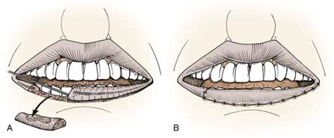 19 Reconstruction Of The Lips Pocket Dentistry