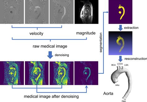 The D Flow Mri Data Processing Stages From The Raw Medical Image To