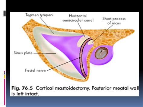 Canal Wall Up Mastoidectomy Intact Bridge Mastoidectomy By Dr Adit My XXX Hot Girl