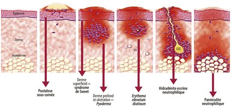 Dermatoses Neutrophiliques Et Localisations