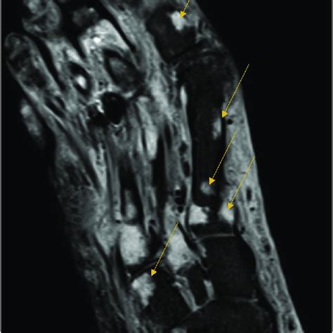 Mri Of The Right Foot Shows Diffuse Soft Tissue Swelling With Mild