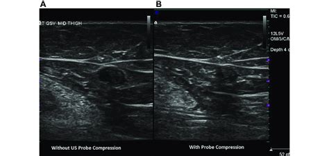 A And B Duplex Ultrasound Us Image Of A Small Partial Opening In A