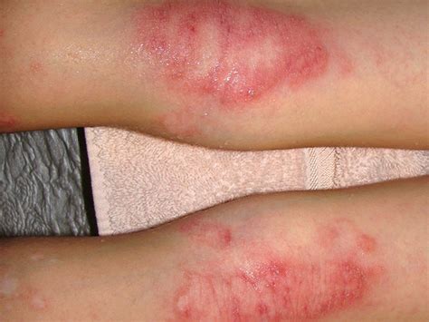 Weeping Eczema Symptoms Causes And Treatment
