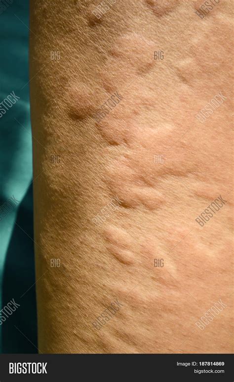 Skin Rash Urticaria Image And Photo Free Trial Bigstock