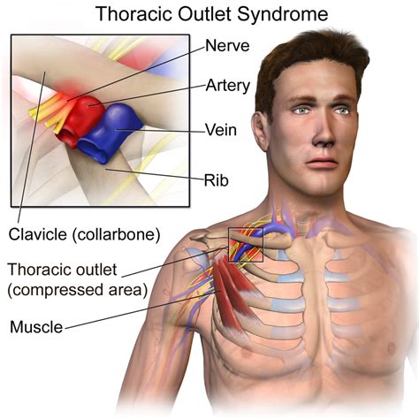 Thoracic Outlet Syndrome An Unheard Of Cause Of Arm Dvt Get Healthy