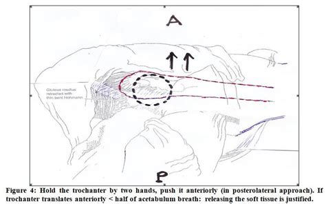 A Test To Evaluate The Mobility Of Trochanter Over Acetabulum During