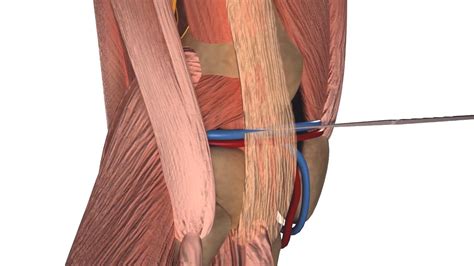 Aaos Ovt Iliotibial Band Syndrome Ultrasonographic Guided Surgery