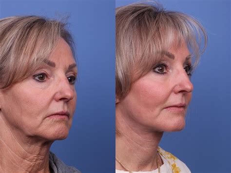 facelift before and after pictures case 312 scottsdale az hobgood facial plastic surgery