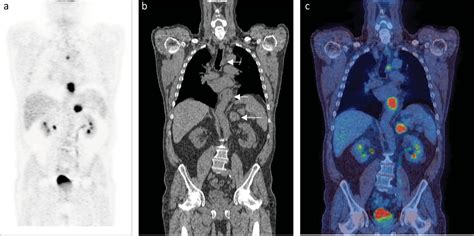 Petct In Oncology Rcp Journals