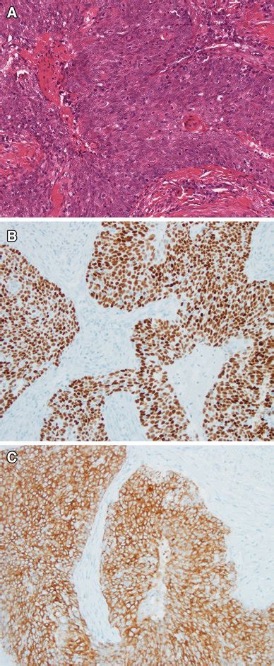 Nonkeratinizing Squamous Cell Carcinoma Of The Oropharynx Hande A