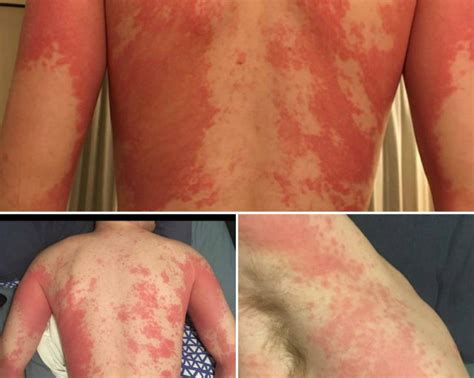 Experts Say Skin Rash Should Be Fourth Official Symptom