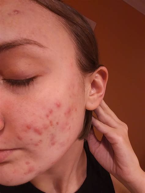 Adult Cystic Acne That Nothing Touches What Am I Missing Here
