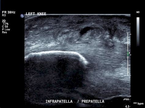 Knee Pathology Ultrasoundpaedia