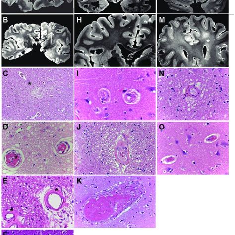 Pdf Brain Histopathology In Patients With Systemic Lupus