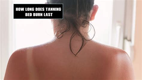 How Long Does Tanning Bed Burn Last
