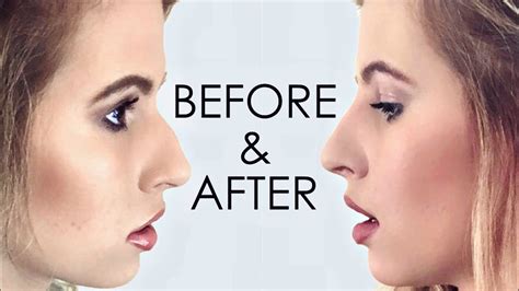 That's because there is none. NON-SURGICAL NOSE JOB RESULTS! I Hannah Leigh - YouTube