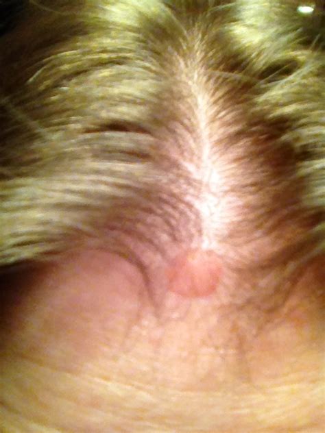 Removing Seborrheic Keratoses Pictures Photos