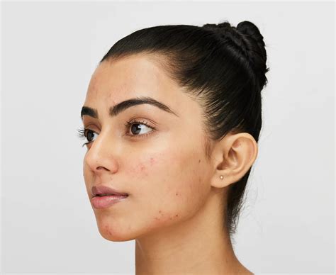 4 Stages Of Acne Types Causes And Prevention Novology
