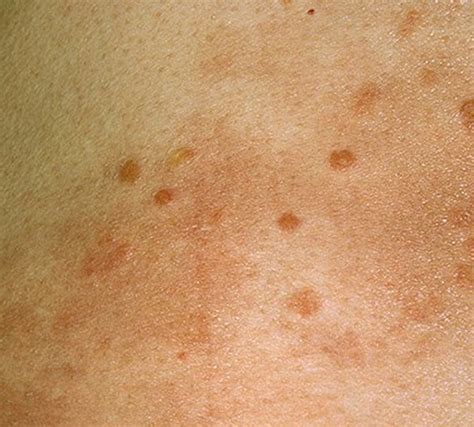 Hiv Skin Rashes Pictures