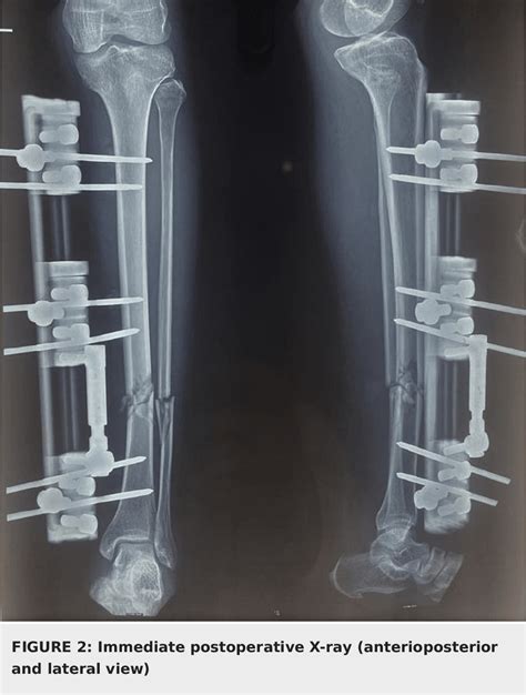 Figure 2 From Management Of Open Tibial Diaphyseal Fractures By Limb