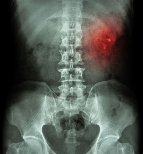 Kub Radiography Abdominal X Ray Kidney X Ray Urology Austin