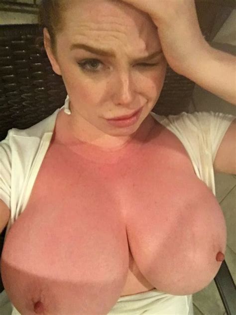 sophie coady s sunburnt boobs porn pic eporner