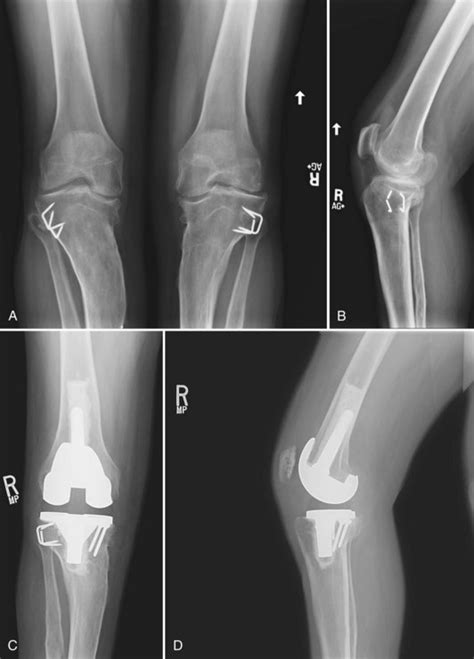 Management Of Extra Articular Deformity In Total Knee Arthroplasty With