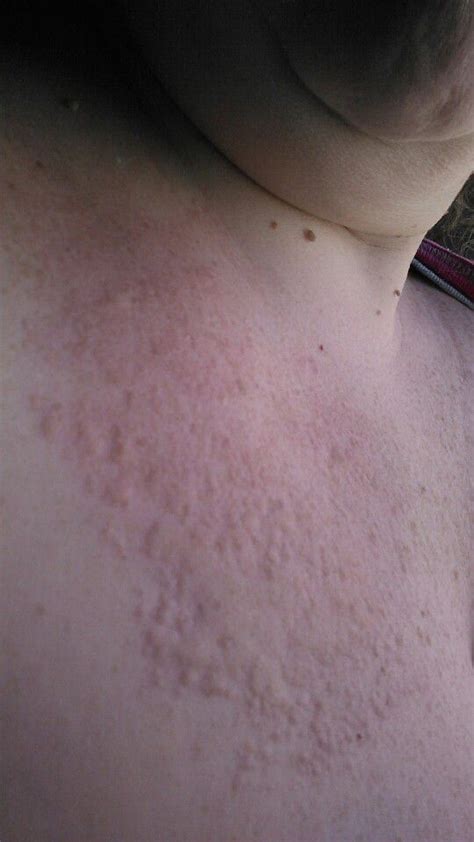 Hives From Chest To Forehead Urticaria Hives It Hurts
