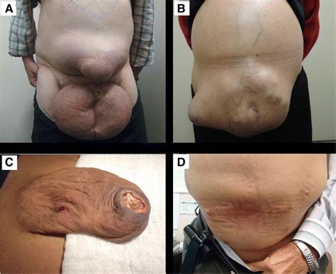 Abdominal Wall Hernia In Cirrhotic Patients Emergency Surgery Results