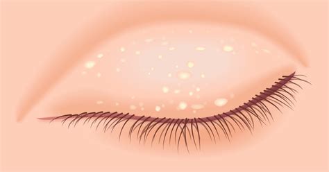How To Get Rid Of Milia Bumps On The Eyelid All About Vision