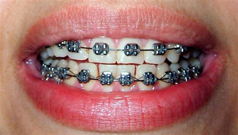 Broken Braces And Brace Wires Symptoms And Solutions