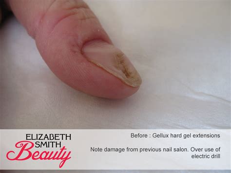 Damage caused by electric nail drill - My Beauty Salon Website Acrylic nails can cause mild infections if not applied properly, leading to damage to the natural nail bed.