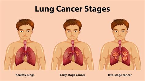 Signs And Symptoms Of Lung Cancer Medserg