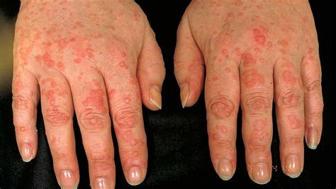 Rare Case Of Acquagenic Urticaria Woman Reports Allergy To Water