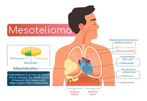 Mesotelioma: cause, sintomi e cura - Farmaco e Cura